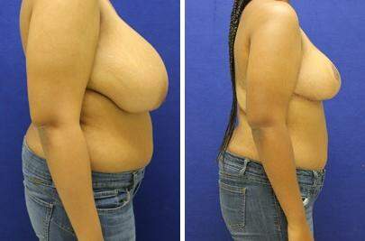 Patient 7634, Breast Reduction Before and After Photos Breast Reduction Before and After Photos in Lexington, KY, Patient 7634
