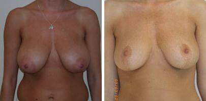 Patient 7704, Breast Reduction Before and After Photos Breast Reduction Before and After Photos in Lexington, KY, Patient 7704
