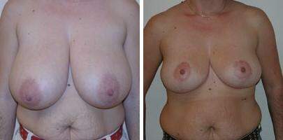 Patient 7714, Breast Reduction Before and After Photos Breast Reduction Before and After Photos in Lexington, KY, Patient 7714