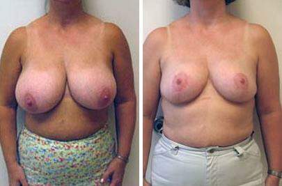 Patient 7724, Breast Reduction Before and After Photos Breast Reduction Before and After Photos in Lexington, KY, Patient 7724