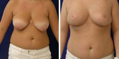 Patient 7734, Breast Reduction Before and After Photos Breast Reduction Before and After Photos in Lexington, KY, Patient 7734