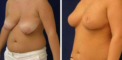 Patient 7734, Breast Reduction Before and After Photos Breast Reduction Before and After Photos in Lexington, KY, Patient 7734