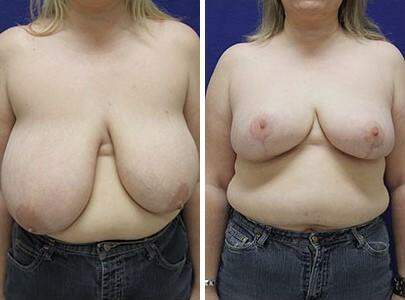 Patient 7744, Breast Reduction Before and After Photos Breast Reduction Before and After Photos in Lexington, KY, Patient 7744