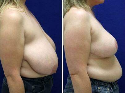 Patient 7744, Breast Reduction Before and After Photos Breast Reduction Before and After Photos in Lexington, KY, Patient 7744