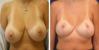 Patient 7670, Breast Reduction Before and After Photos Breast Reduction Before and After Photos in Lexington, KY, Patient 7670