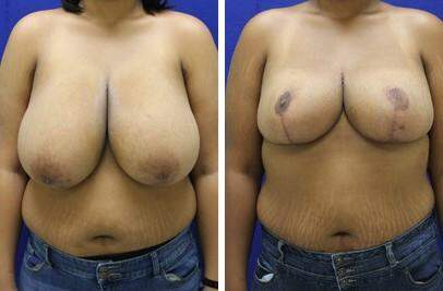 Patient 7634, Breast Reduction Before and After Photos Breast Reduction Before and After Photos in Lexington, KY, Patient 7634