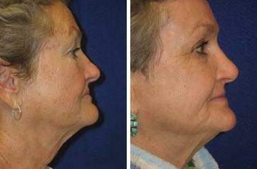 Patient 6902, C02 Laser Skin Rejuvenation Before and After Photos C02 Laser Skin Rejuvenation Before and After Photos in Lexington, KY, Patient 6902