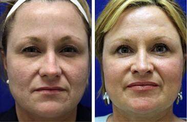 Patient 6932, C02 Laser Skin Rejuvenation Before and After Photos C02 Laser Skin Rejuvenation Before and After Photos in Lexington, KY, Patient 6932