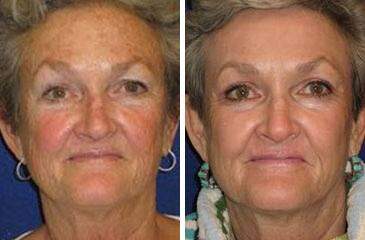 Patient 6902, C02 Laser Skin Rejuvenation Before and After Photos C02 Laser Skin Rejuvenation Before and After Photos in Lexington, KY, Patient 6902