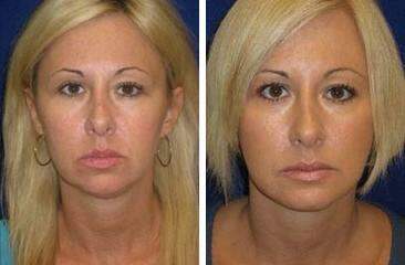 Patient 6710, Chin Augmentation Before and After Photos Chin Augmentation Before and After Photos in Lexington, KY, Patient 6710