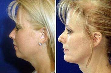 Patient 6720, Chin Augmentation Before and After Photos Chin Augmentation Before and After Photos in Lexington, KY, Patient 6720