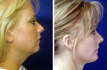 Patient 6720, Chin Augmentation Before and After Photos Chin Augmentation Before and After Photos in Lexington, KY, Patient 6720