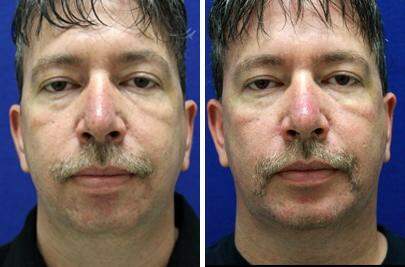 Patient 6753, Chin Augmentation Before and After Photos Chin Augmentation Before and After Photos in Lexington, KY, Patient 6753