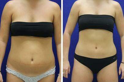 Patient 7340, CoolSculpting® Before and After Photos CoolSculpting® Before and After Photos in Lexington, KY, Patient 7340
