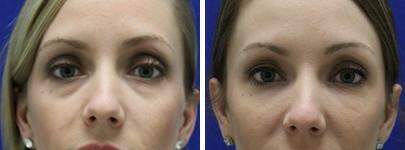 Patient 6858, Injectable Fillers Before and After Photos Injectable Fillers Before and After Photos in Lexington, KY, Patient 6858