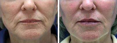 Patient 6868, Injectable Fillers Before and After Photos Injectable Fillers Before and After Photos in Lexington, KY, Patient 6868