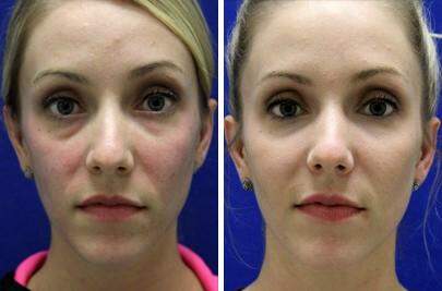 Patient 6888, Injectable Fillers Before and After Photos Injectable Fillers Before and After Photos in Lexington, KY, Patient 6888