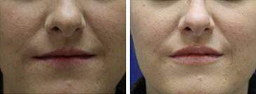 Patient 6822, Injectable Fillers Before and After Photos Injectable Fillers Before and After Photos in Lexington, KY, Patient 6822