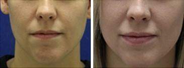Patient 6826, Injectable Fillers Before and After Photos Injectable Fillers Before and After Photos in Lexington, KY, Patient 6826