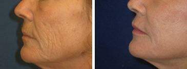 Injectable Fillers Before and After Photos in Lexington, KY, Patient 6830