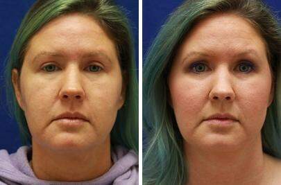Patient 6810, Injectable Fillers Before and After Photos Injectable Fillers Before and After Photos in Lexington, KY, Patient 6810