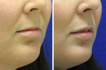 Patient 6936, Lip Enhancement Before and After Photos Lip Enhancement Before and After Photos in Lexington, KY, Patient 6936