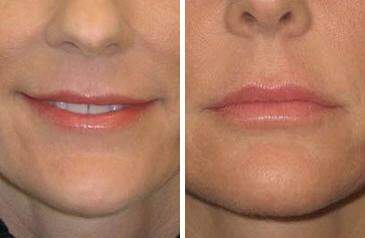 Patient 6970, Lip Enhancement Before and After Photos Lip Enhancement Before and After Photos in Lexington, KY, Patient 6970