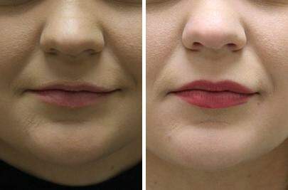 Patient 7000, Lip Enhancement Before and After Photos Lip Enhancement Before and After Photos in Lexington, KY, Patient 7000