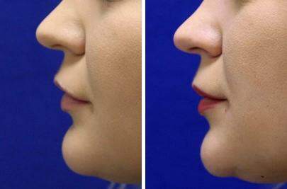 Patient 7000, Lip Enhancement Before and After Photos Lip Enhancement Before and After Photos in Lexington, KY, Patient 7000
