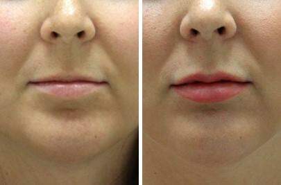 Patient 7010, Lip Enhancement Before and After Photos Lip Enhancement Before and After Photos in Lexington, KY, Patient 7010
