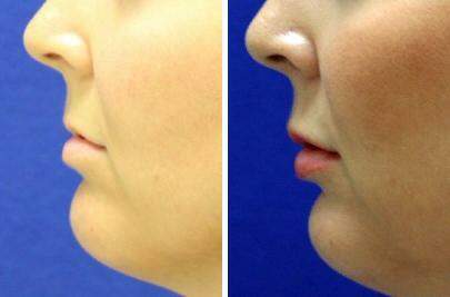 Patient 7010, Lip Enhancement Before and After Photos Lip Enhancement Before and After Photos in Lexington, KY, Patient 7010