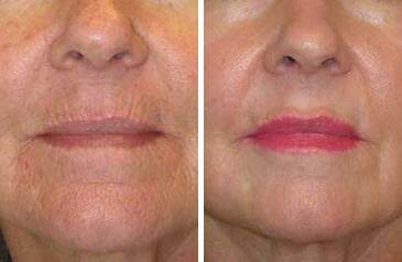 Patient 6946, Lip Enhancement Before and After Photos Lip Enhancement Before and After Photos in Lexington, KY, Patient 6946