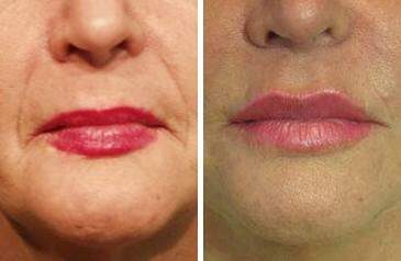 Patient 6956, Lip Enhancement Before and After Photos Lip Enhancement Before and After Photos in Lexington, KY, Patient 6956
