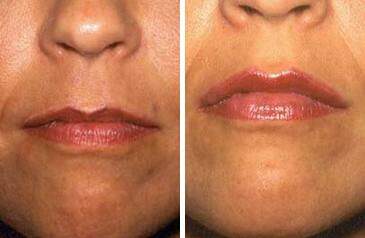 Patient 6966, Lip Enhancement Before and After Photos Lip Enhancement Before and After Photos in Lexington, KY, Patient 6966