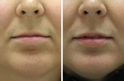 Patient 6936, Lip Enhancement Before and After Photos Lip Enhancement Before and After Photos in Lexington, KY, Patient 6936