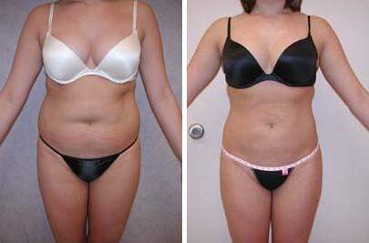 Patient 7564, Liposuction Before and After Photos Liposuction Before and After Photos in Lexington, KY, Patient 7564