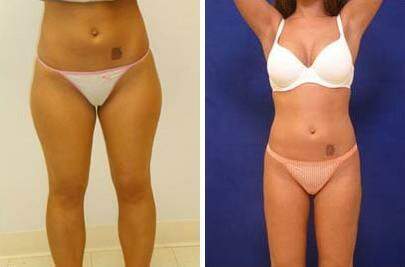 Patient 7574, Liposuction Before and After Photos Liposuction Before and After Photos in Lexington, KY, Patient 7574