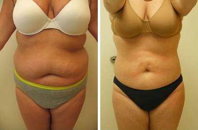 Patient 7584, Liposuction Before and After Photos Liposuction Before and After Photos in Lexington, KY, Patient 7584