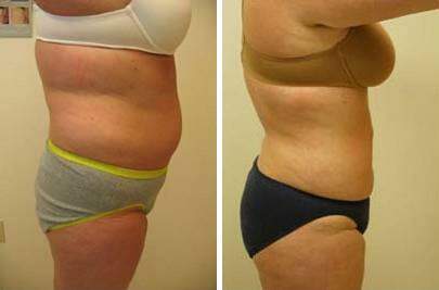 Patient 7584, Liposuction Before and After Photos Liposuction Before and After Photos in Lexington, KY, Patient 7584