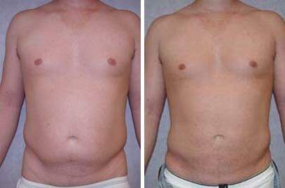 Patient 7594, Liposuction Before and After Photos Liposuction Before and After Photos in Lexington, KY, Patient 7594