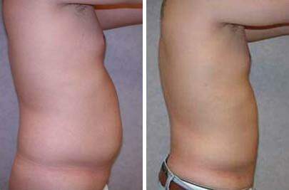 Patient 7594, Liposuction Before and After Photos Liposuction Before and After Photos in Lexington, KY, Patient 7594