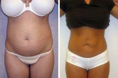 Patient 7604, Liposuction Before and After Photos Liposuction Before and After Photos in Lexington, KY, Patient 7604