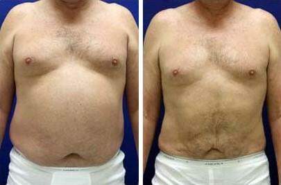 Patient 7614, Liposuction Before and After Photos Liposuction Before and After Photos in Lexington, KY, Patient 7614