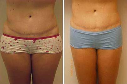 Patient 7534, Liposuction Before and After Photos Liposuction Before and After Photos in Lexington, KY, Patient 7534