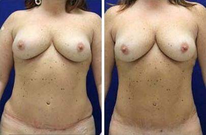 Patient 7624, Liposuction Before and After Photos Liposuction Before and After Photos in Lexington, KY, Patient 7624