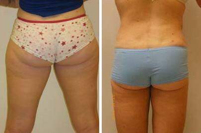 Patient 7534, Liposuction Before and After Photos Liposuction Before and After Photos in Lexington, KY, Patient 7534