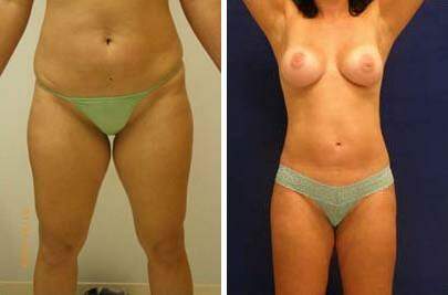 Patient 7554, Liposuction Before and After Photos Liposuction Before and After Photos in Lexington, KY, Patient 7554