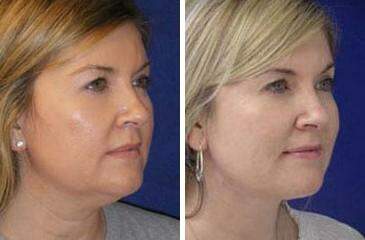 Patient 7228, Neck Liposuction Before and After Photos Neck Liposuction Before and After Photos in Lexington, KY, Patient 7228