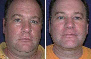 Patient 7239, Neck Liposuction Before and After Photos Neck Liposuction Before and After Photos in Lexington, KY, Patient 7239