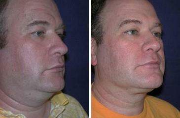 Patient 7239, Neck Liposuction Before and After Photos Neck Liposuction Before and After Photos in Lexington, KY, Patient 7239
